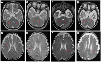 Krabbe Disease Associated With Mitochondrial Dysfunction in a Chinese Family